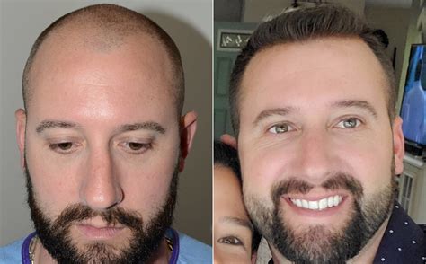 Mens hair replacement. Things To Know About Mens hair replacement. 
